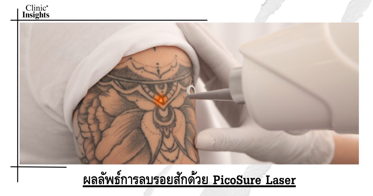 ผลลัพธ์การลบรอยสักด้วย PicoSure Laser