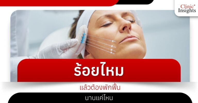 ร้อยไหมแล้วต้องพักฟื้นนานแค่ไหน