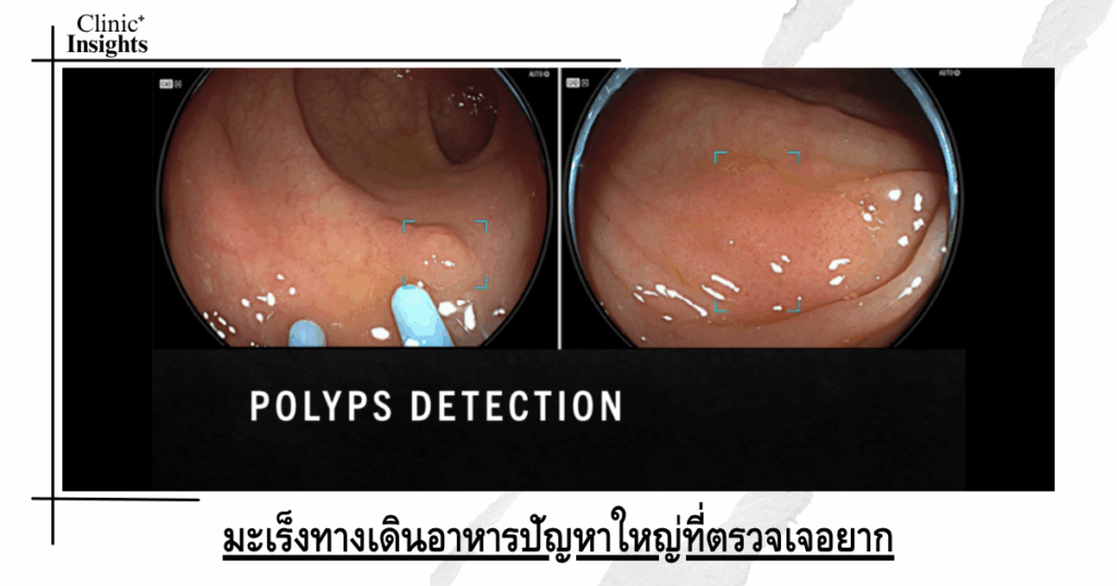 Gastrointestinal cancer is a major problem that is difficult to detect.