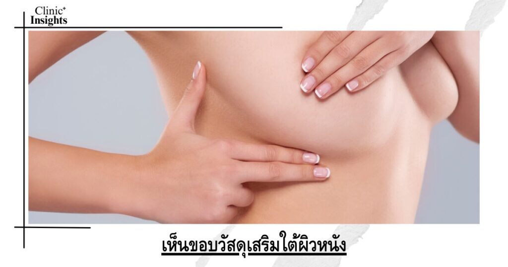 เห็นขอบวัสดุเสริมใต้ผิวหนัง