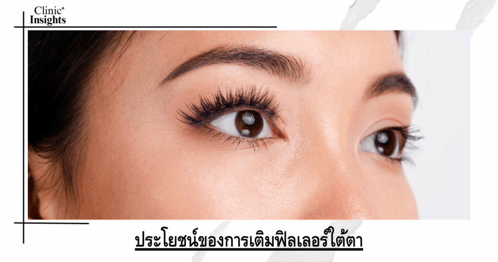 Benefits of under-eye fillers