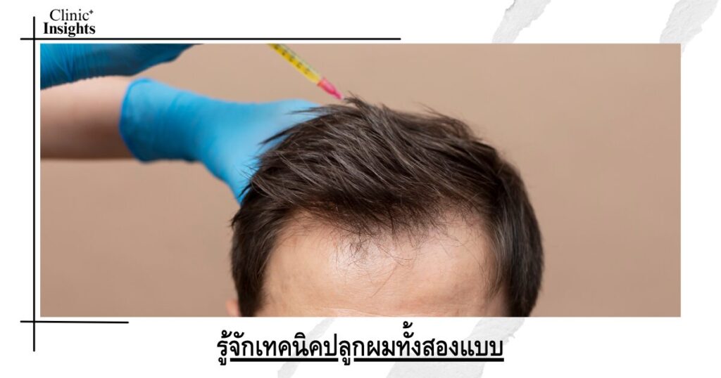 รู้จักเทคนิคปลูกผมทั้งสองแบบ

