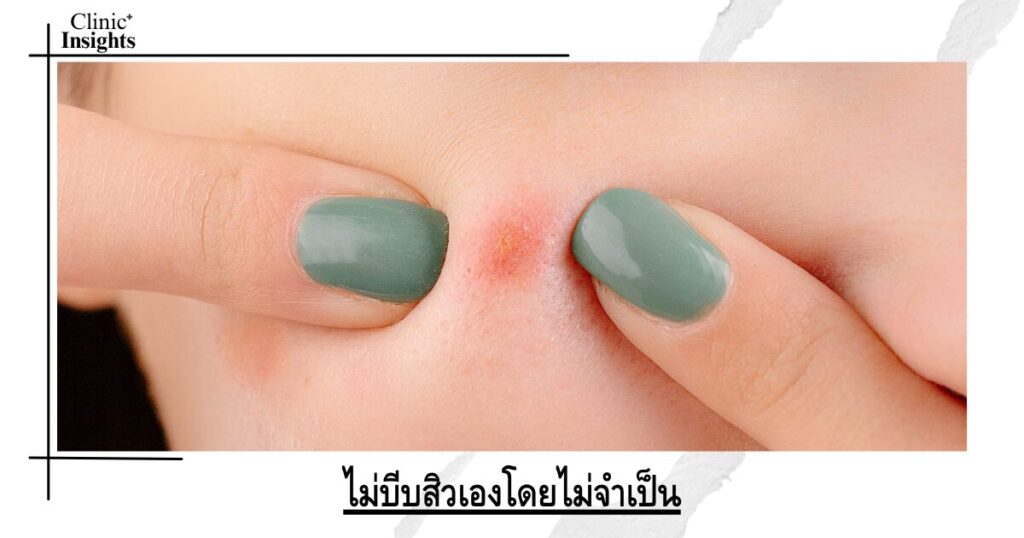 ไม่บีบสิวเองโดยไม่จำเป็น
