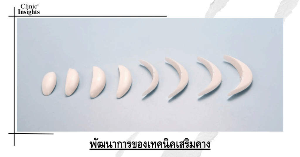Evolution of chin augmentation techniques
