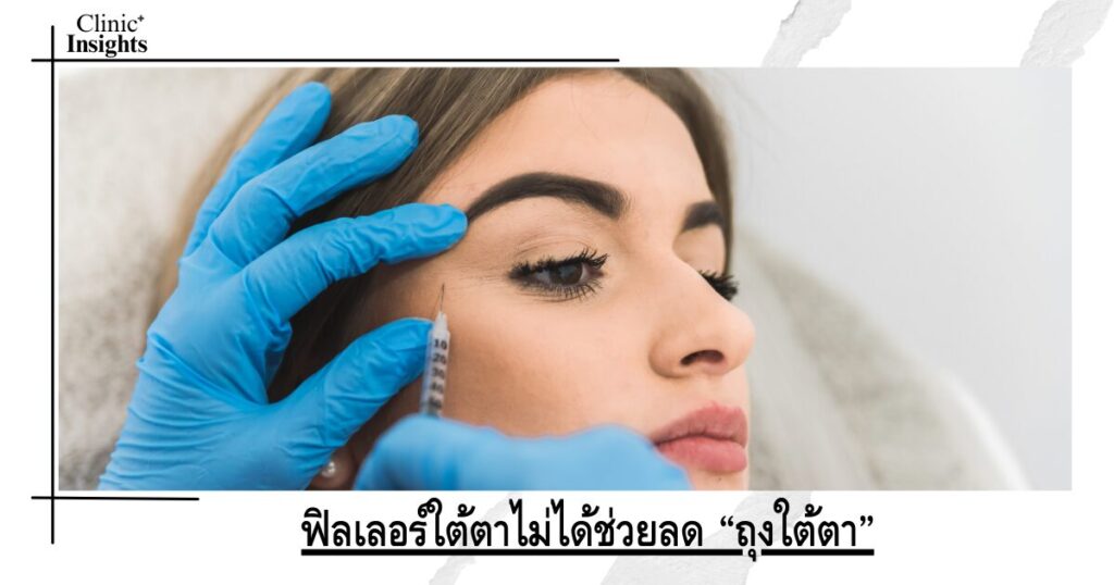 ฟิลเลอร์ใต้ตาไม่ได้ช่วยลด “ถุงใต้ตา”