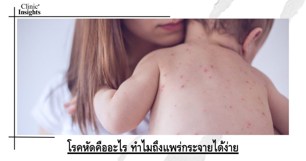 What is measles and why is it so contagious?