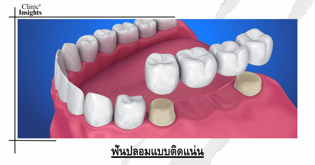 Fixed dentures