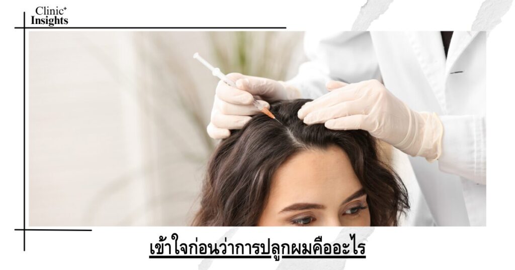 เข้าใจก่อนว่าการปลูกผมคืออะไร