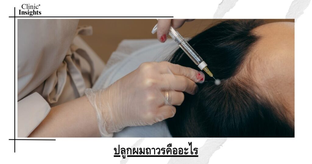 ปลูกผมถาวรคืออะไร
