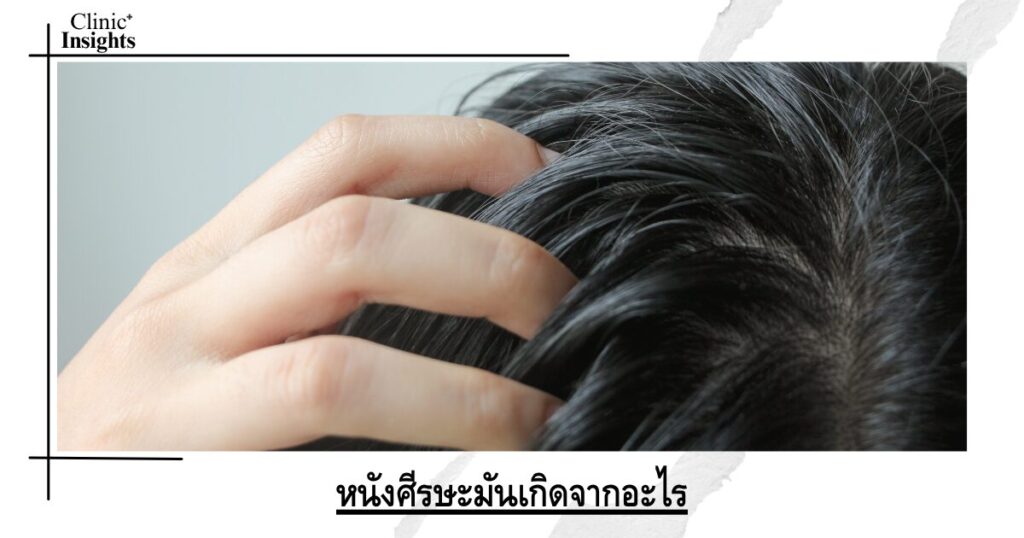หนังศีรษะมันเกิดจากอะไร
