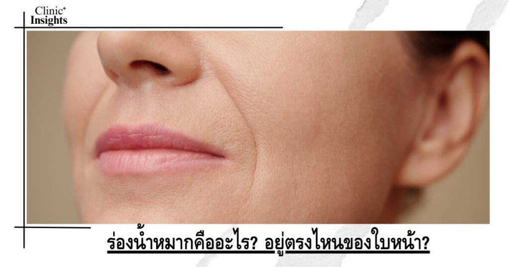 ร่องน้ำหมากคืออะไร_ อยู่ตรงไหนของใบหน้า