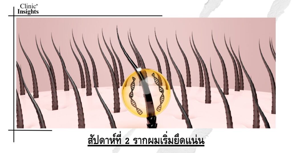 สัปดาห์ที่ 2 รากผมเริ่มยึดแน่น