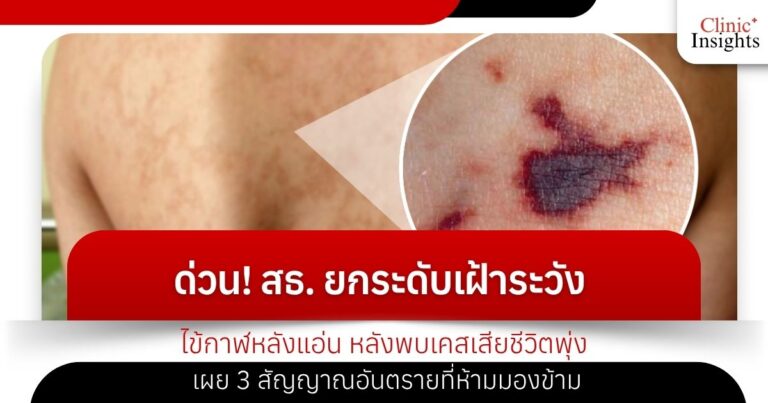 ด่วน! สธ. ยกระดับเฝ้าระวัง _ไข้กาฬหลังแอ่น_ หลังพบเคสเสียชีวิตพุ่ง เผย 3