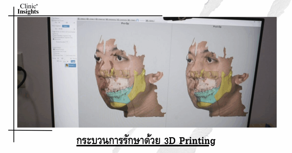 3D Printing Treatment Process