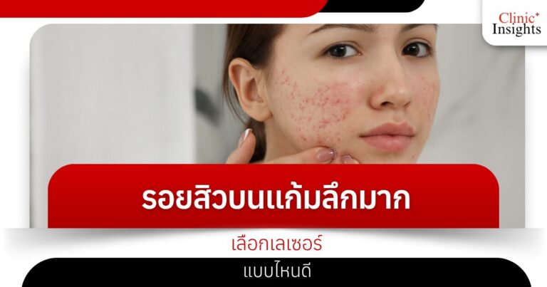 รอยสิวบนแก้มลึกมาก เลือกเลเซอร์แบบไหนดี