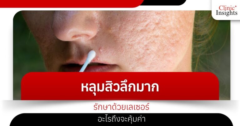 หลุมสิวลึกมากรักษาด้วยเลเซอร์อะไรถึงจะคุ้มค่า