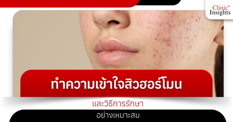 ทำความเข้าใจ​สิวฮอร์โมน และวิธีการรักษา​อย่างเหมาะสม