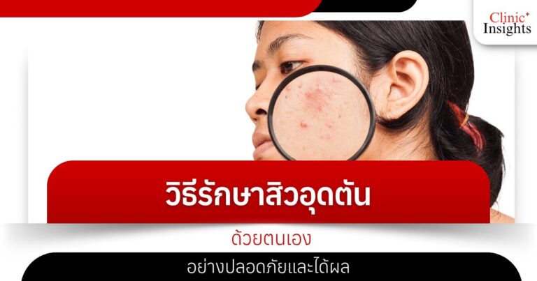วิธีรักษาสิวอุดตันด้วยตนเองอย่างปลอดภัยและได้ผล