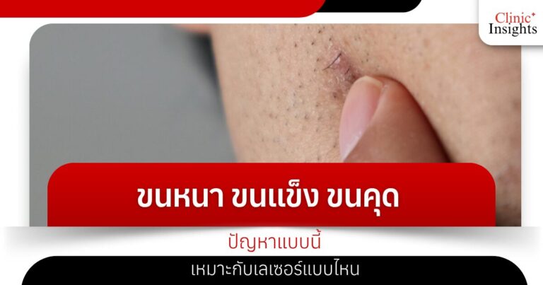 ขนหนา ขนแข็ง ขนคุด ปัญหาแบบนี้เหมาะกับเลเซอร์แบบไหน