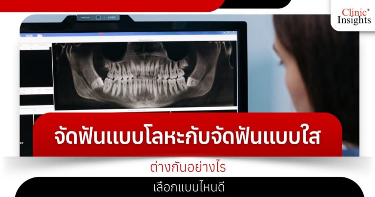 จัดฟันแบบโลหะกับจัดฟันแบบใส ต่างกันอย่างไร เลือกแบบไหนดี​