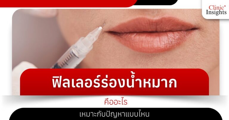 ฟิลเลอร์ร่องน้ำหมากคืออะไร เหมาะกับปัญหาแบบไหน