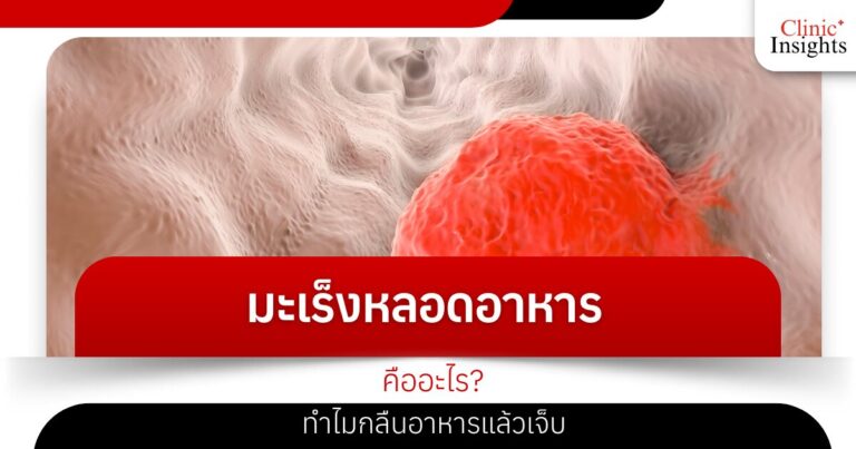 มะเร็งหลอดอาหาร คืออะไร ทำไมกลืนอาหารแล้วเจ็บ