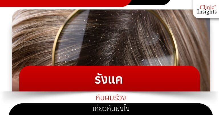 รังแคกับผมร่วงเกี่ยวกันยังไง