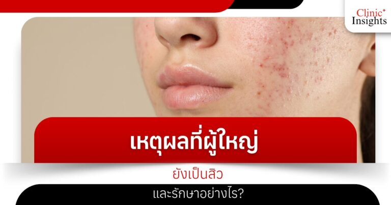 เหตุผลที่ผู้ใหญ่ยังเป็นสิว และรักษาอย่างไร_​