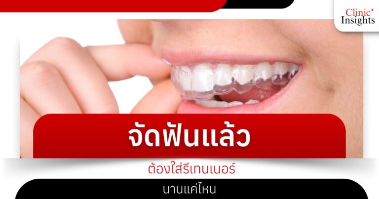 จัดฟันแล้วต้องใส่รีเทนเนอร์นานแค่ไหน