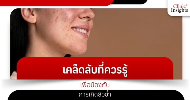 เคล็ดลับที่ควรรู้​เพื่อป้องกันการเกิดสิวซ้ำ