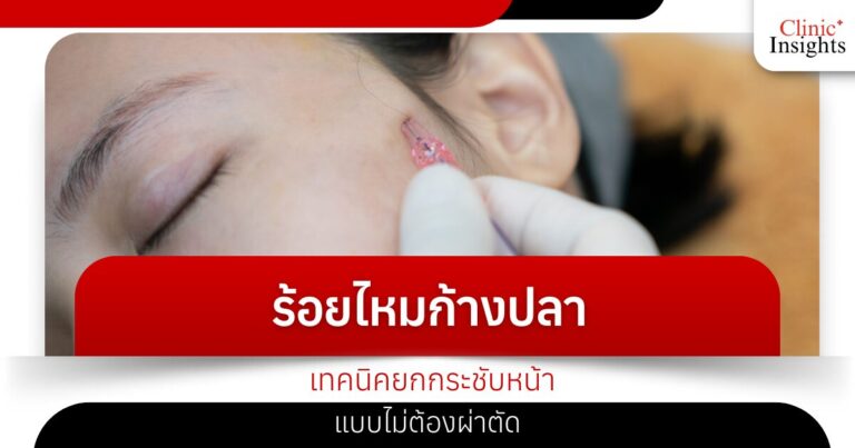 ร้อยไหมก้างปลา เทคนิคยกกระชับหน้าแบบไม่ต้องผ่าตัด