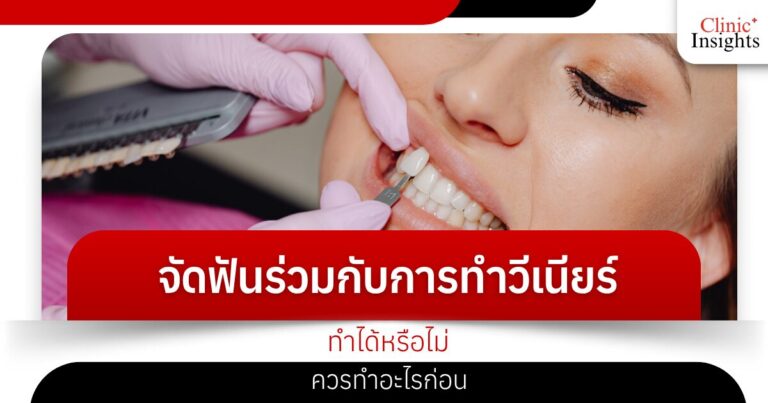 จัดฟันร่วมกับการทำวีเนียร์ ทำได้หรือไม่ ควรทำอะไรก่อน​
