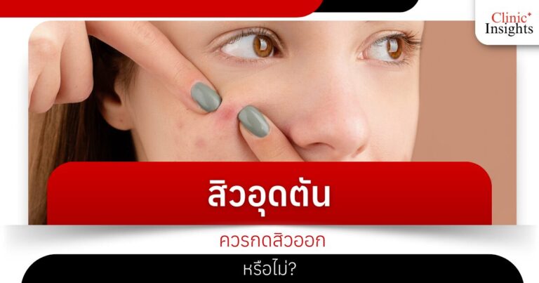 สิวอุดตันควรกดสิวออกหรือไม่