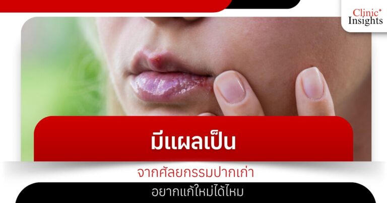 มีแผลเป็นจากศัลยกรรมปากเก่า อยากแก้ใหม่ได้ไหม