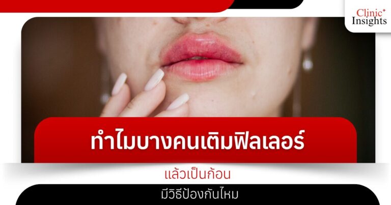 ทำไมบางคนเติมฟิลเลอร์แล้วเป็นก้อน มีวิธีป้องกันไหม