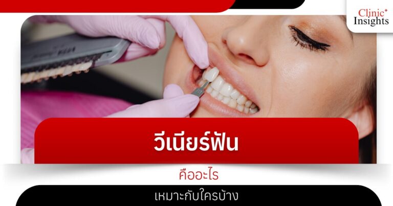 วีเนียร์ฟันคืออะไร เหมาะกับใครบ้าง​