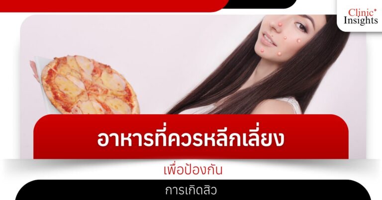 อาหารที่ควรหลีกเลี่ยงเพื่อป้องกันการเกิดสิว​