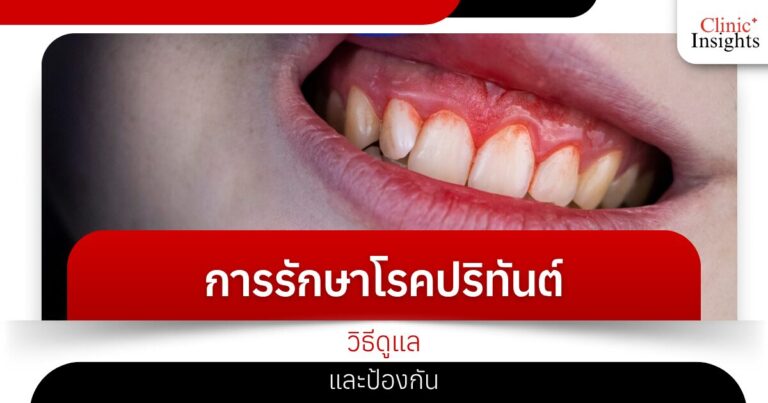 การรักษาโรคปริทันต์ วิธีดูแลและป้องกัน​