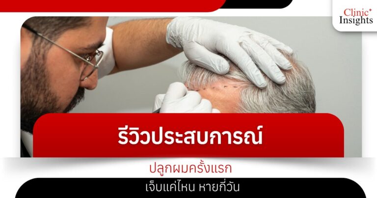 รีวิวประสบการณ์ปลูกผมครั้งแรก เจ็บแค่ไหน หายกี่วัน