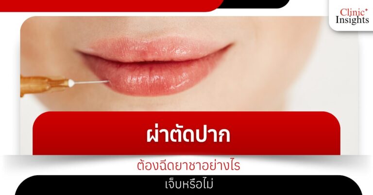 ผ่าตัดปากต้องฉีดยาชาอย่างไร เจ็บหรือไม่