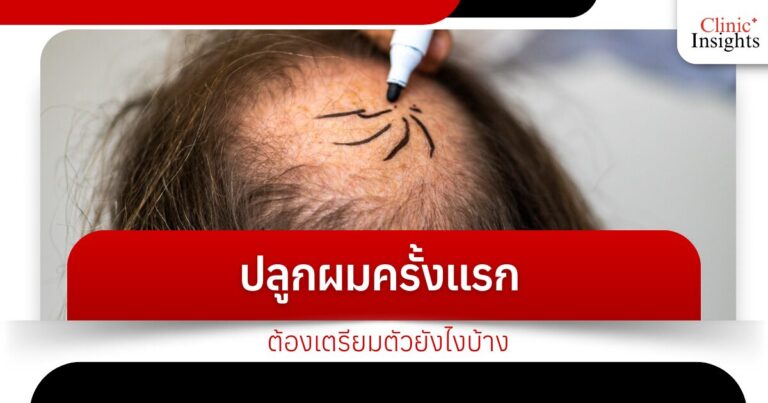 ปลูกผมครั้งแรกต้องเตรียมตัวยังไงบ้าง