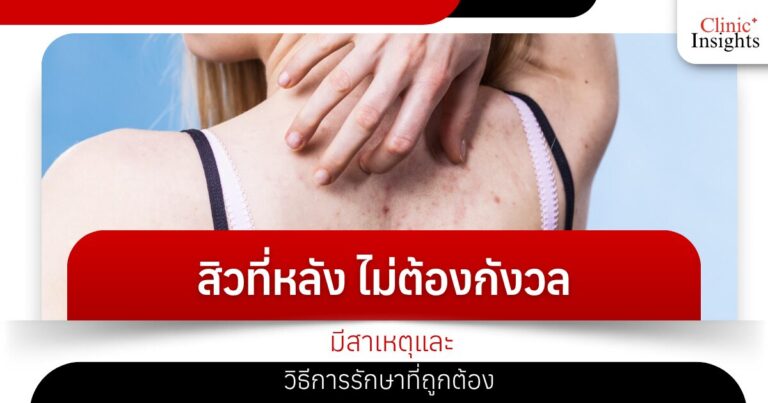 สิวที่หลัง ไม่ต้องกังวล มีสาเหตุและวิธีการรักษา​ที่ถูกต้อง