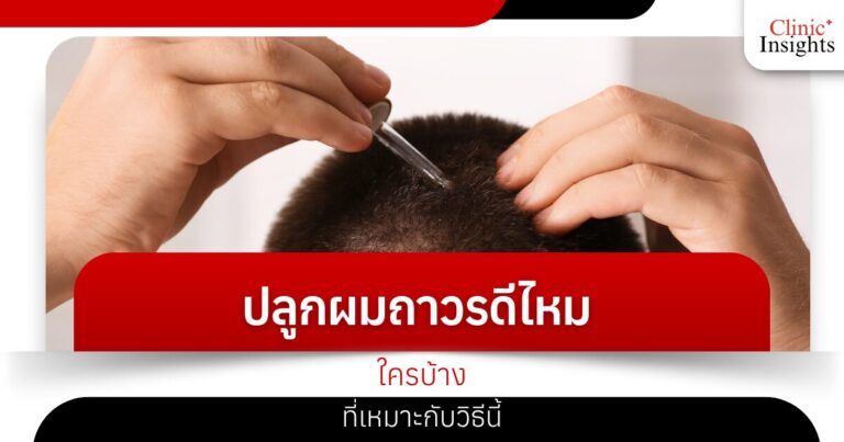 ปลูกผมถาวรดีไหม ใครบ้างที่เหมาะกับวิธีนี้