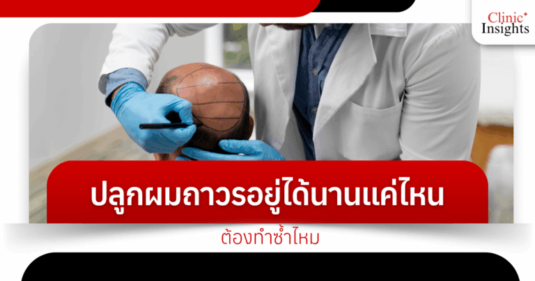 How long does a permanent hair transplant last? Do I need to repeat it?