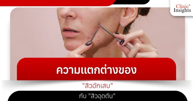 ความแตกต่างของ _​สิวอักเสบ_ กับ _สิวอุดตัน