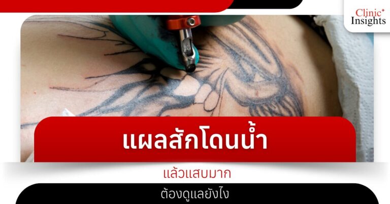 แผลสักโดนน้ำแล้วแสบมากต้องดูแลยังไง