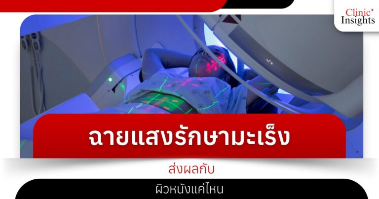 ฉายแสงรักษามะเร็งส่งผลกับผิวหนังแค่ไหน