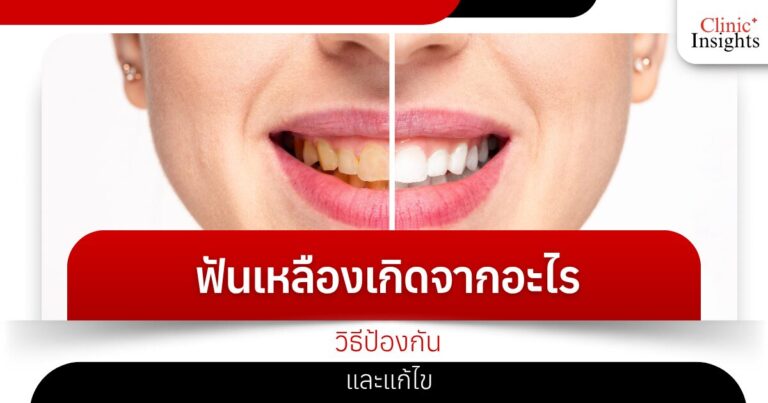 ฟันเหลืองเกิดจากอะไร วิธีป้องกันและแก้ไข​