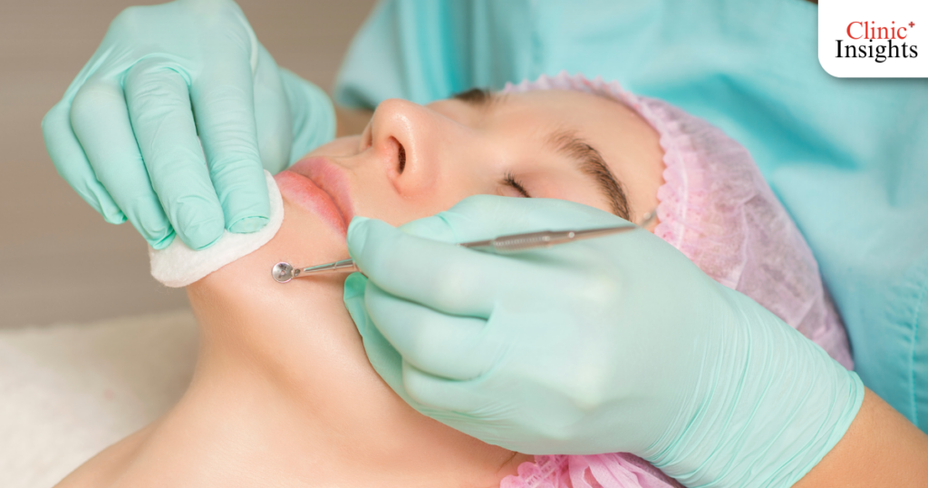 การกดสิว (Acne Extraction) - พื้นฐานที่ขาดไม่ได้