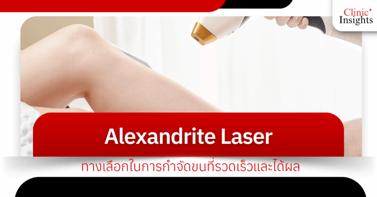 Alexandrite Laser: A fast and effective hair removal option